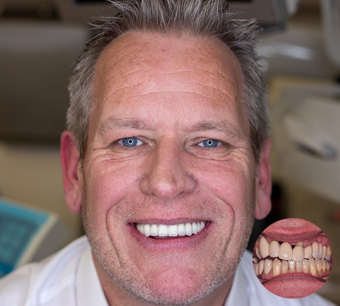 After having All on 4 Dental Implants treatment