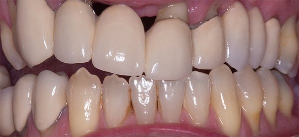 Dental Implants Aberdeen