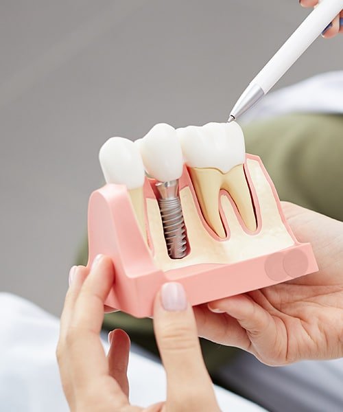 dental implants Aberdeen