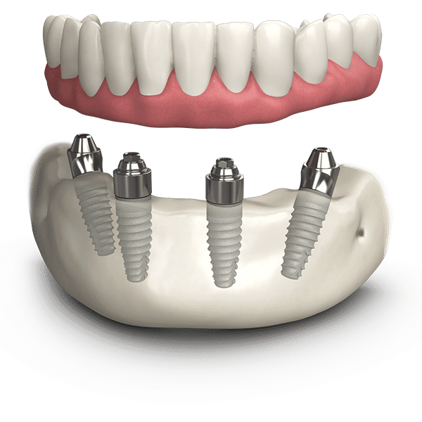 dental implants aberdeen prices